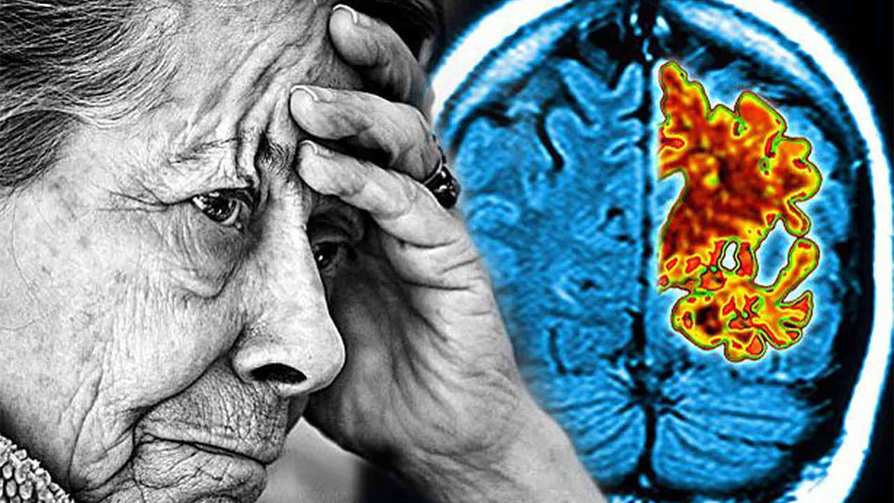 Alzheimer hastalığının görülme sıklığının