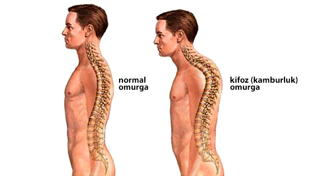 Kifoz tedavisinin kifozun türü,